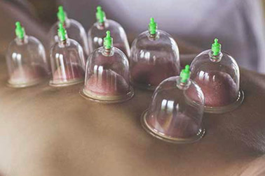 Cupping